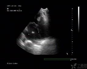 成人心脏彩超视频教学